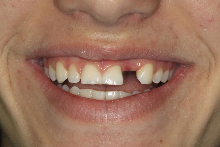 before getting dental implants at Alpine Family Dental