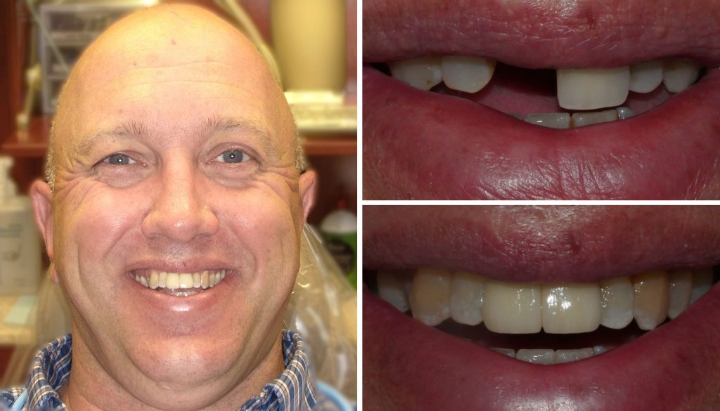 before and after getting dental implants at Alpine Family Dental