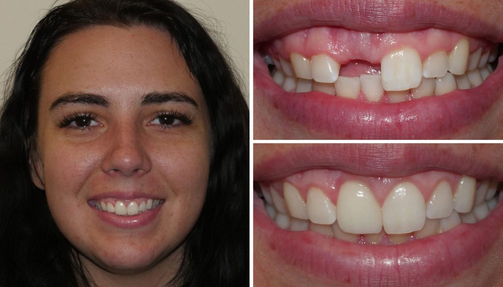 before and after getting dental implants at Alpine Family Dental