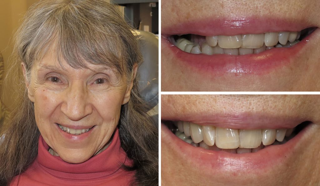 before and after getting dental implants at Alpine Family Dental