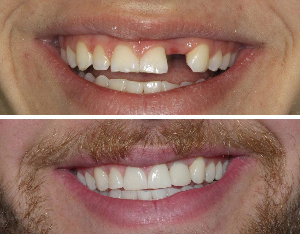 before and after getting dental implants at Alpine Family Dental