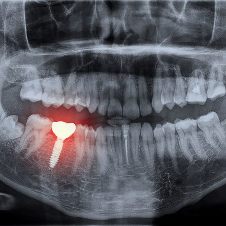dental implant on an x-ray