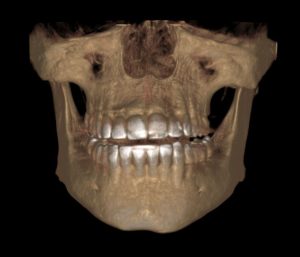 x-ray of the jaw
